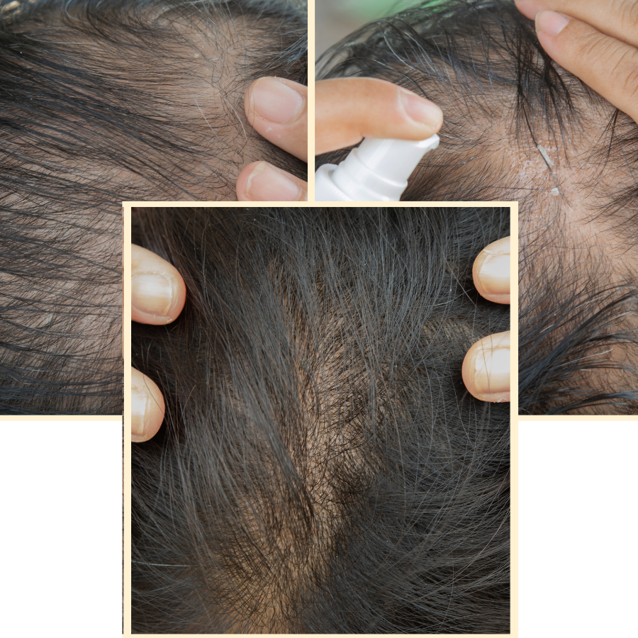 Sử dụng minoxidil hàng ngày tránh ngắt quãng